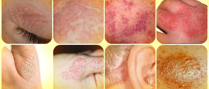 types of psoriasis